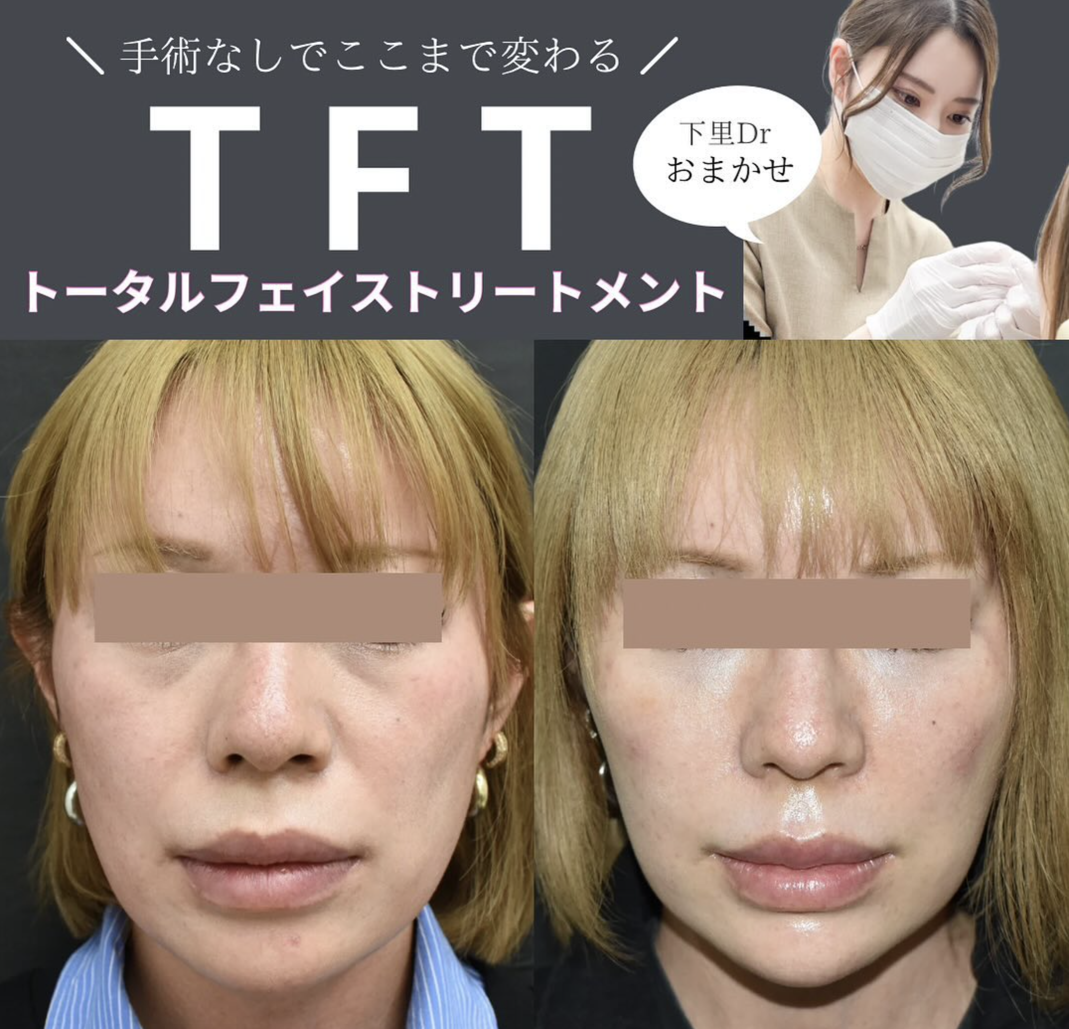 フェイシャル・フィラー 注入の極意と部位別テクニック Amazon.co.jp: フェイシャル・フィラー : 岩城佳津美: 本