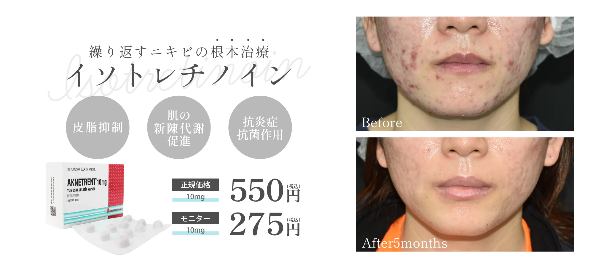 イソトレチノインでニキビ治療を受けた方の症例